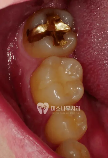 금 크라운 치아