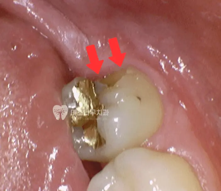 깨진 치아