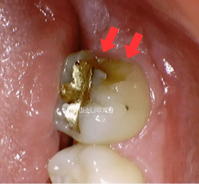 깨진 치아