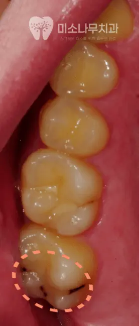 썩은 이