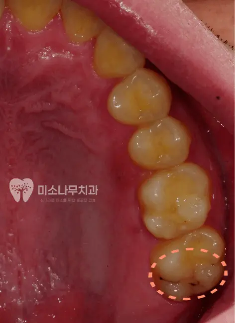 썩은 이