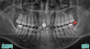 임플란트 케이스