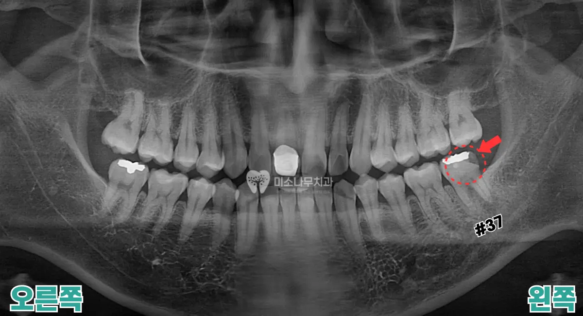 임플란트 케이스