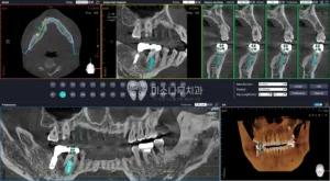 치아 엑스레이 사진