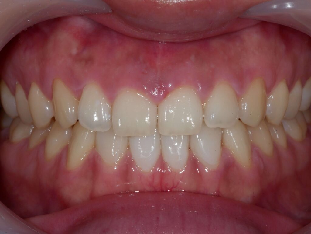 라미네이트 후 사진