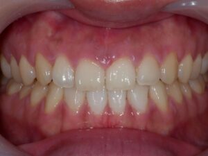 라미네이트 후 사진