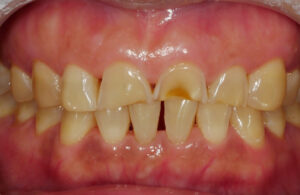 무삭제 라미네이트 치료 전 사진