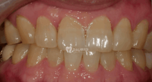 치료 전 치아 사진